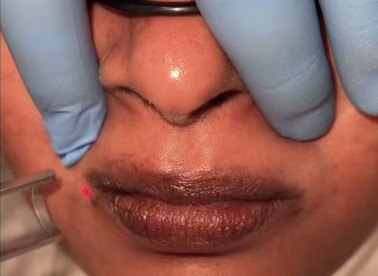 Depigmentation laser